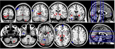 Local Neuronal Synchronization in Frequent Nightmare Recallers and Healthy Controls: A Resting-State Functional Magnetic Resonance Imaging Study